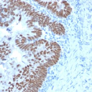 Formalin-fixed, paraffin-embedded human Colon Carcinoma stained with CDX2 Mouse Monoclonal Antibody (CDX2/2214).