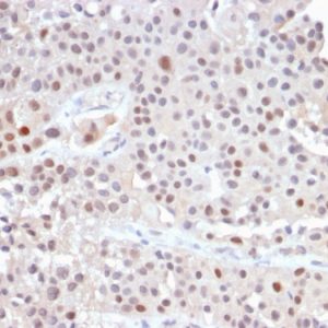 Formalin-fixed, paraffin-embedded human Urothelial Carcinoma stained with p21 Rabbit Recombinant Monoclonal Antibody (CIP1/2489R).