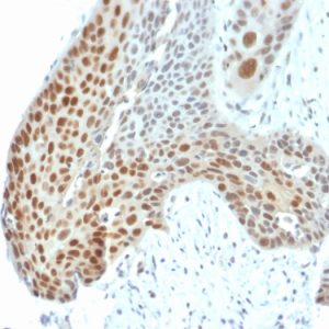 Formalin-fixed, paraffin-embedded human Cervical Tumor stained with Phospho c-Jun Mouse Monoclonal Antibody (C-J 4C4/1).