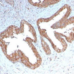 Formalin-fixed, paraffin-embedded human Prostate Carcinoma stained with COX-2 Recombinant Rabbit Monoclonal Antibody (COX2/3232R).