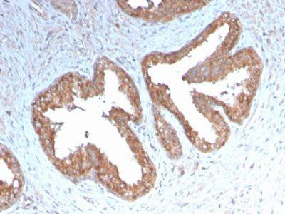 Formalin-fixed, paraffin-embedded human Prostate Carcinoma stained with COX-2 Recombinant Rabbit Monoclonal Antibody (COX2/3232R).