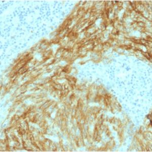 Formalin-fixed, paraffin-embedded human Follicular Dendritic Cell Sarcoma stained with CD21 / CR2 Mouse Monoclonal Antibody (CR2/1952).