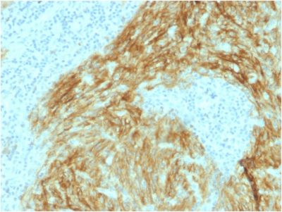 Formalin-fixed, paraffin-embedded human Follicular Dendritic Cell Sarcoma stained with CD21 / CR2 Mouse Monoclonal Antibody (CR2/1952).