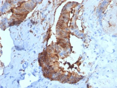 Formalin-fixed, paraffin-embedded human Renal Cell Carcinoma stained with Cathepsin D Mouse Monoclonal Antibody (CTSD/2781).