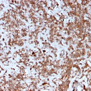 Formalin-fixed, paraffin-embedded human Liver stained with Cathepsin K Mouse Monoclonal Antibody (CTSK/2792).