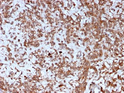 Formalin-fixed, paraffin-embedded human Liver stained with Cathepsin K Mouse Monoclonal Antibody (CTSK/2792).