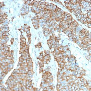 Formalin-fixed, paraffin-embedded human Neuroendocrine Tumor stained with Drebrin-1 Mouse Monoclonal Antibody (DBN1/3393).
