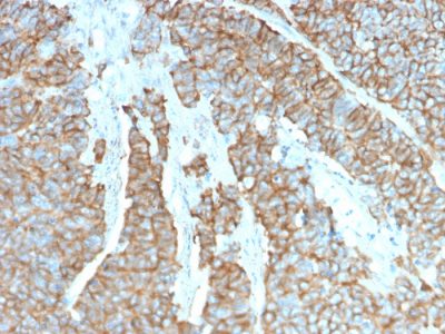 Formalin-fixed, paraffin-embedded human Neuroendocrine Tumor stained with Drebrin-1 Mouse Monoclonal Antibody (DBN1/3393).