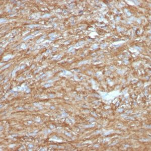 Formalin-fixed, paraffin-embedded human GIST stained with DOG-1 Rabbit Recombinant Monoclonal Antibody (DG1/2831R).