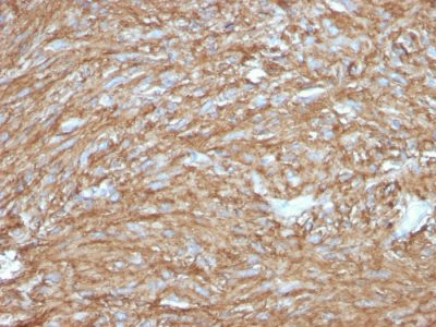 Formalin-fixed, paraffin-embedded human GIST stained with DOG-1 Rabbit Recombinant Monoclonal Antibody (DG1/2831R).