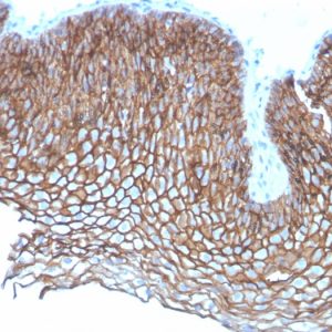 Formalin-fixed, paraffin-embedded human Esophageal Carcinoma stained with Desmoglein-3 Mouse Monoclonal Antibody (DSG3/2837).