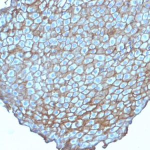 Formalin-fixed, paraffin-embedded human Esophageal Carcinoma stained with Desmoglein-3 Mouse Monoclonal Antibody (DSG3/2838).