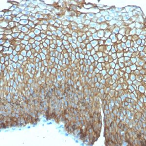 Formalin-fixed, paraffin-embedded human Esophageal Carcinoma stained with Desmoglein-3 Mouse Monoclonal Antibody (DSG3/2839).