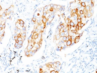 Formalin-fixed, paraffin-embedded human Lung SCC stained with Cytokeratin 7/17 Mouse Monoclonal Antibody (C-46).