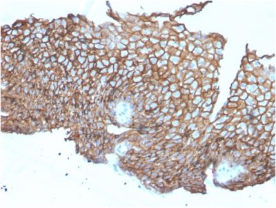 Formalin-fixed, paraffin-embedded human Esophageal Carcinoma stained with Desmoglein-3 Mouse Monoclonal Antibody (DSG3/2840).