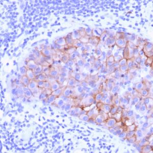 Formalin-fixed, paraffin-embedded human Breast Carcinoma stained with HER-2 Mouse Monoclonal Antibody (ERBB2/3078).