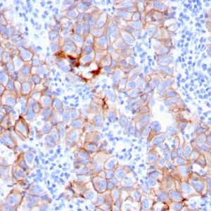 Formalin-fixed, paraffin-embedded human Breast Carcinoma stained with HER-2 Mouse Monoclonal Antibody (ERBB2/3080).