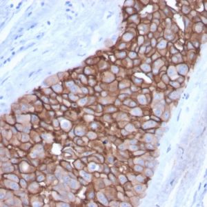 Formalin-fixed, paraffin-embedded human Breast Carcinoma stained with HER-2 Mouse Monoclonal Antibody (ERBB2/3092).