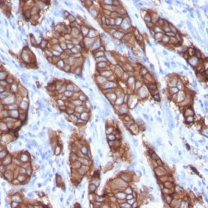 Formalin-fixed, paraffin-embedded human Breast Carcinoma stained with HER-2 Monospecific Mouse Monoclonal Antibody (ERBB2/3093).