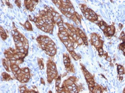 Formalin-fixed, paraffin-embedded human Breast Carcinoma stained with HER-2 Monospecific Mouse Monoclonal Antibody (ERBB2/3093).