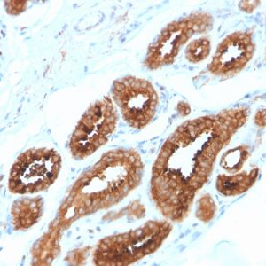 Formalin-fixed, paraffin-embedded human Breast Carcinoma stained with HER-4 / ERBB4 Mouse Monoclonal Antibody (ERBB4/2581).