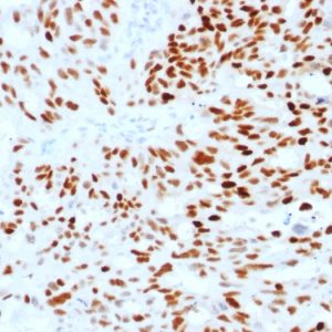 Formalin-fixed, paraffin-embedded human Endometrial Carcinoma stained with Estrogen Receptor alpha Mouse Monoclonal Antibody (ESR1/1904).