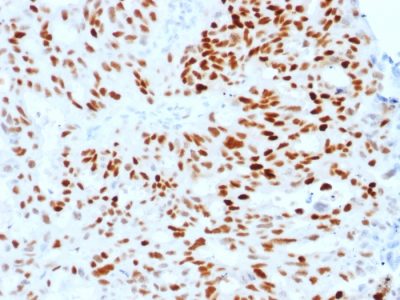 Formalin-fixed, paraffin-embedded human Endometrial Carcinoma stained with Estrogen Receptor alpha Mouse Monoclonal Antibody (ESR1/1904).