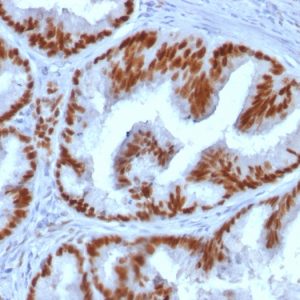 Formalin-fixed, paraffin-embedded human Endometrial Carcinoma stained with Estrogen Receptor alpha Mouse Monoclonal Antibody (ESR1/1935).