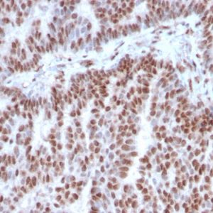 Formalin-fixed, paraffin-embedded human Breast Carcinoma stained with Estrogen Receptor alpha Mouse Monoclonal Antibody (ESR1/3342).