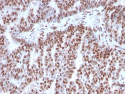 Formalin-fixed, paraffin-embedded human Breast Carcinoma stained with Estrogen Receptor alpha Mouse Monoclonal Antibody (ESR1/3342).