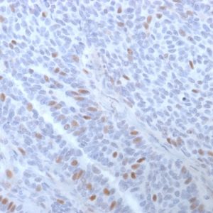 Formalin-fixed, paraffin-embedded human Breast Carcinoma stained with Estrogen Receptor alpha Mouse Monoclonal Antibody (ESR1/3373).