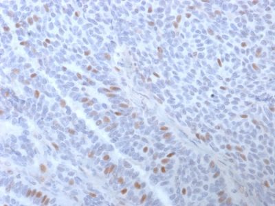 Formalin-fixed, paraffin-embedded human Breast Carcinoma stained with Estrogen Receptor alpha Mouse Monoclonal Antibody (ESR1/3373).