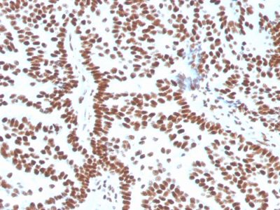 Formalin-fixed, paraffin-embedded human Breast Carcinoma stained with Estrogen Receptor alpha Mouse Monoclonal Antibody (ESR1/3556).