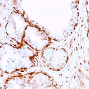 Formalin-fixed, paraffin-embedded human Prostate Tumor stained with AKR1B1 Mouse Monoclonal Antibody (CPTC-AKR1B1-3).