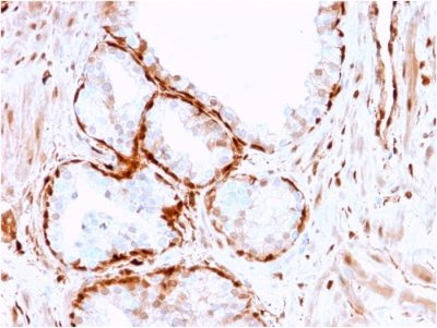 Formalin-fixed, paraffin-embedded human Prostate Tumor stained with AKR1B1 Mouse Monoclonal Antibody (CPTC-AKR1B1-3).