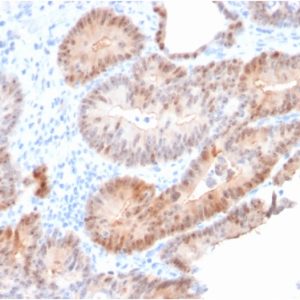 Formalin-fixed, paraffin-embedded human Prostate Carcinoma stained with AKR1C2 Mouse Monoclonal Antibody (CPTC-AKR1C2-1).