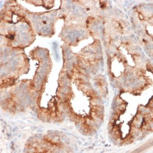 Formalin-fixed, paraffin-embedded human Prostate Carcinoma stained with FOLH1 Mouse Monoclonal Antibody (FOLH1/2354).