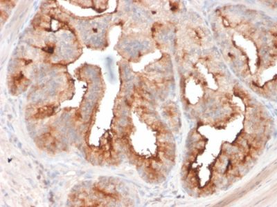 Formalin-fixed, paraffin-embedded human Prostate Carcinoma stained with FOLH1 Mouse Monoclonal Antibody (FOLH1/2354).
