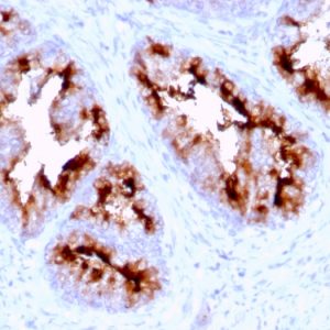 Formalin-fixed, paraffin-embedded human Prostate Carcinoma stained with FOLH1 (PSMA) Mouse Monoclonal Antibody (FOLH1/2363).