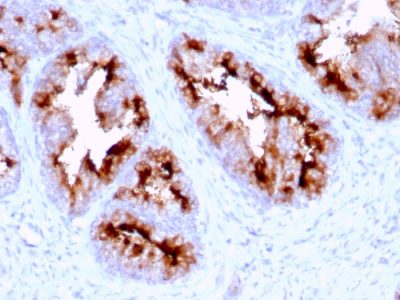 Formalin-fixed, paraffin-embedded human Prostate Carcinoma stained with FOLH1 (PSMA) Mouse Monoclonal Antibody (FOLH1/2363).