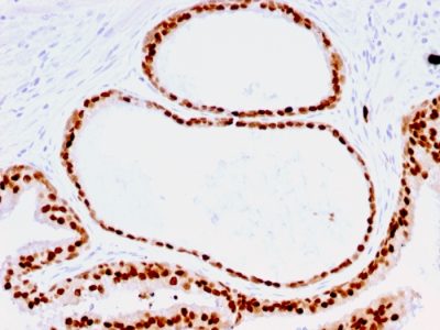 Formalin-fixed, paraffin-embedded human Prostate stained with FOXA1 Mouse Monoclonal Antibody (FOXA1/1516).