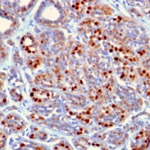Formalin-fixed, paraffin-embedded human Breast Carcinoma stained with GATA-3 Mouse Monoclonal Antibody (GATA3/2442).