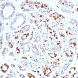 Formalin-fixed, paraffin-embedded human Breast Carcinoma stained with GATA-3 Mouse Monoclonal Antibody (GATA3/2444).