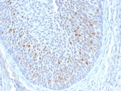 Formalin-fixed, paraffin-embedded human Cervix stained with HPV-18 Mouse Monoclonal Antibody (HPV16 E1/E4).