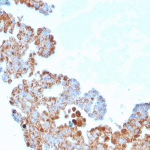 Formalin-fixed, paraffin-embedded human Breast Carcinoma stained with CDC34 Mouse Monoclonal Antibody (CPTC-CDC34-2).