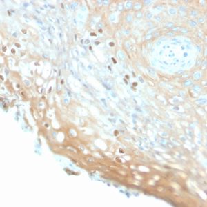 Formalin-fixed, paraffin-embedded human Cervix stained with HPV16 Rabbit Recombinant Monoclonal Antibody (HPV16/2058R).