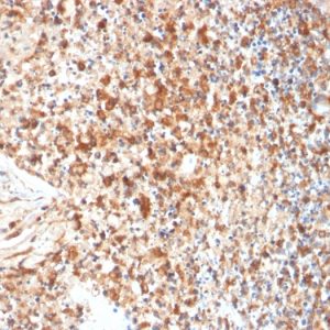 Formalin-fixed, paraffin-embedded human Cervix stained with HSVI Mouse Monoclonal Antibody (HSVI/2095).