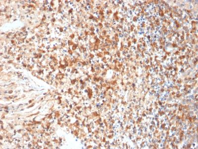 Formalin-fixed, paraffin-embedded human Cervix stained with HSVI Mouse Monoclonal Antibody (HSVI/2095).