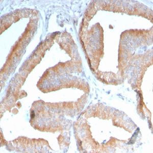 Formalin-fixed, paraffin-embedded human Prostate Carcinoma stained with ICOS-L Mouse Monoclonal Antibody (ICOSL/3111).