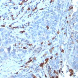 Formalin-fixed, paraffin-embedded human Tumor stained with IgM Recombinant Rabbit Monoclonal Antibody (IGHM/3135R).